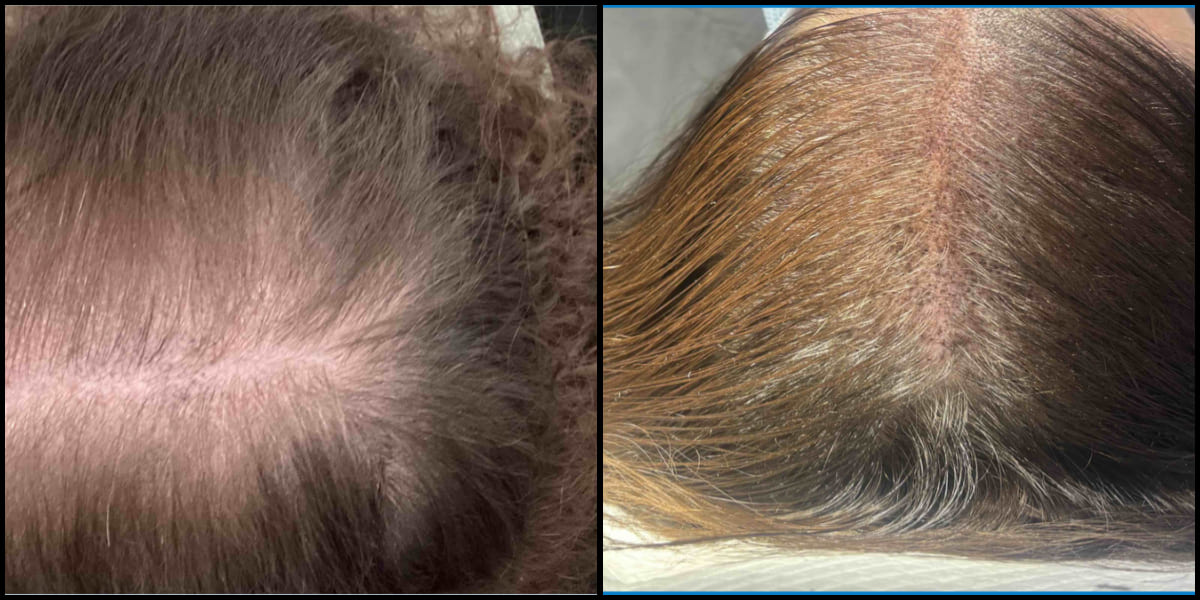 Before and after hair restoration result 3