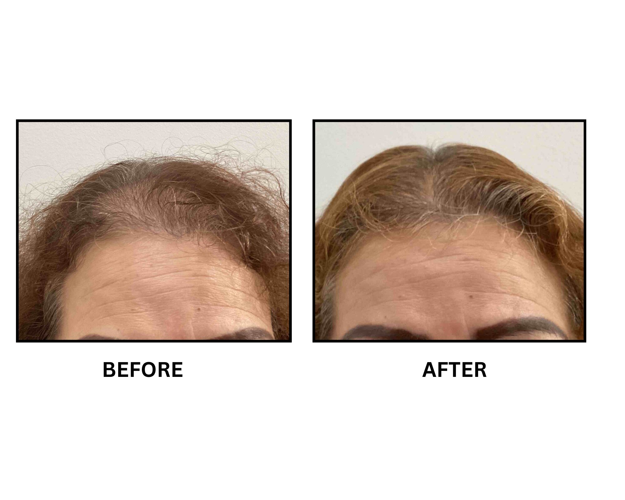 Before and after hair restoration result 4