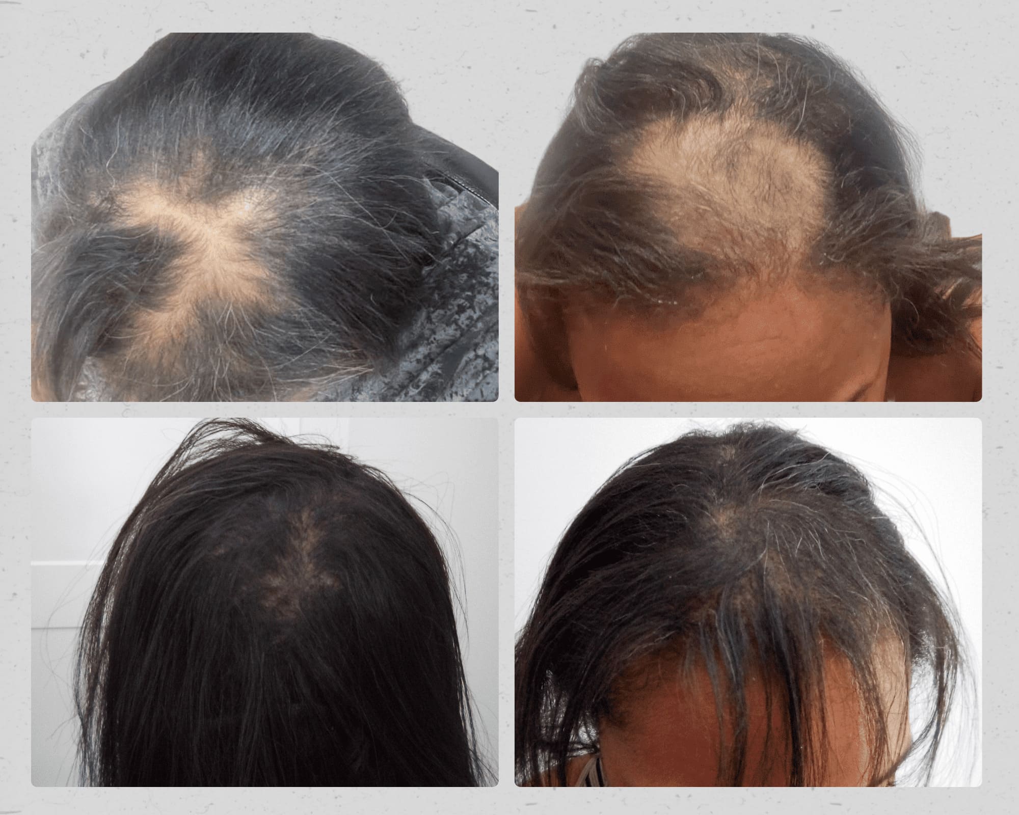 Before and after hair restoration result 5