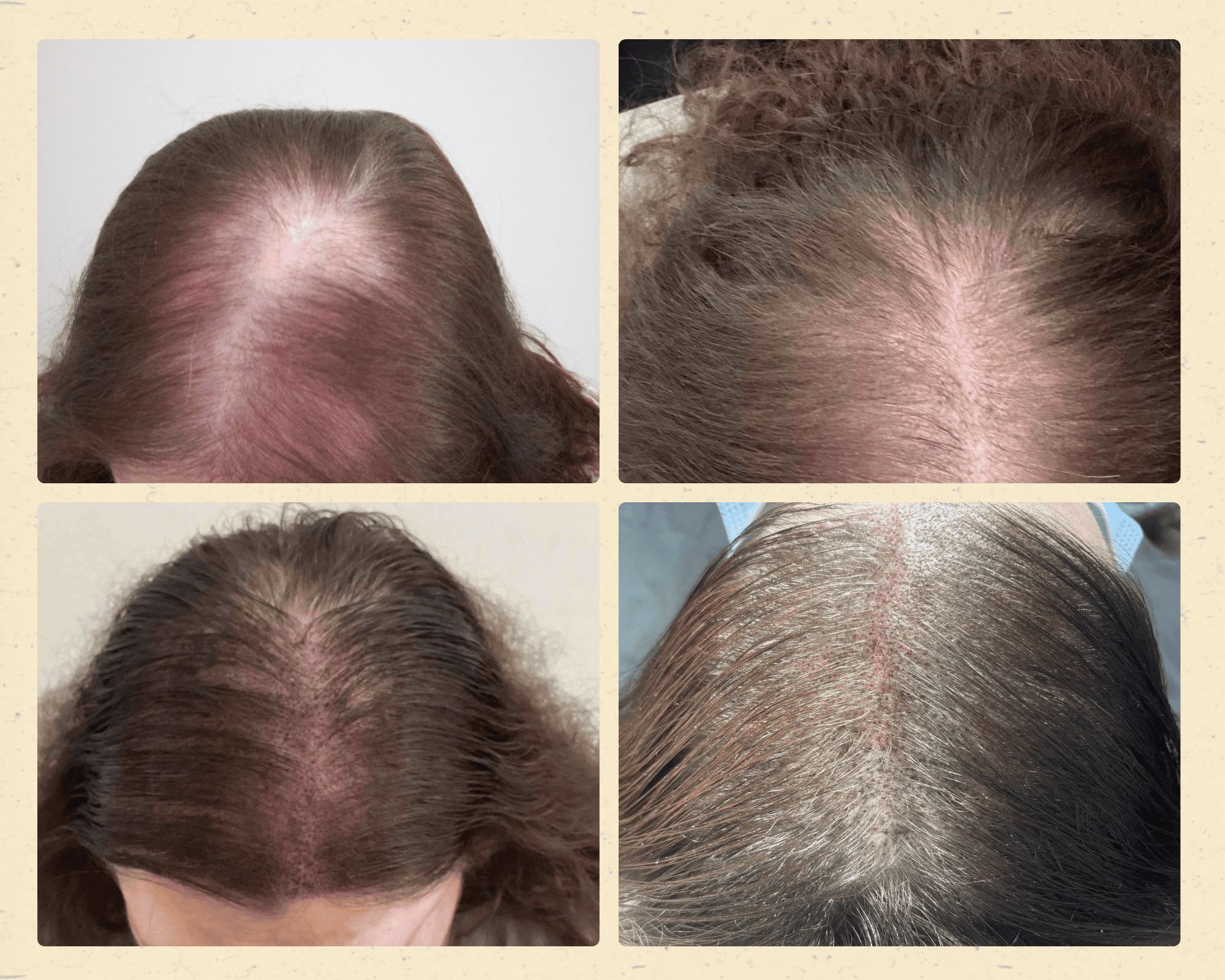 Before and after hair restoration result 6