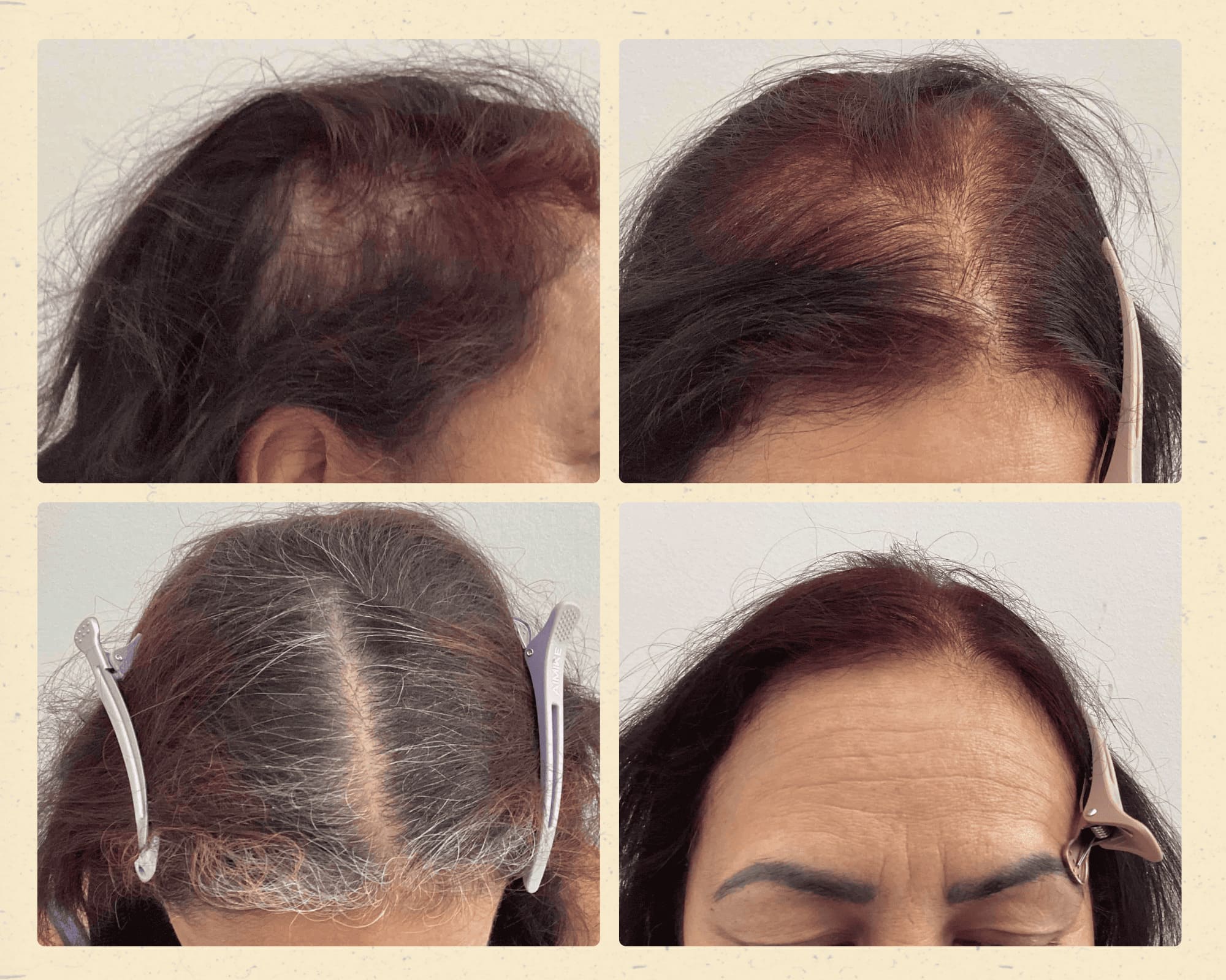 Before and after hair restoration result 7